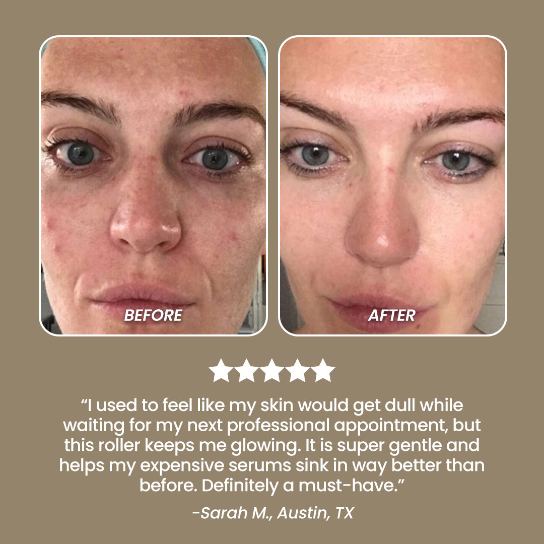 SkinNeedlePro™ Derma Roller for In-Between Microneedling