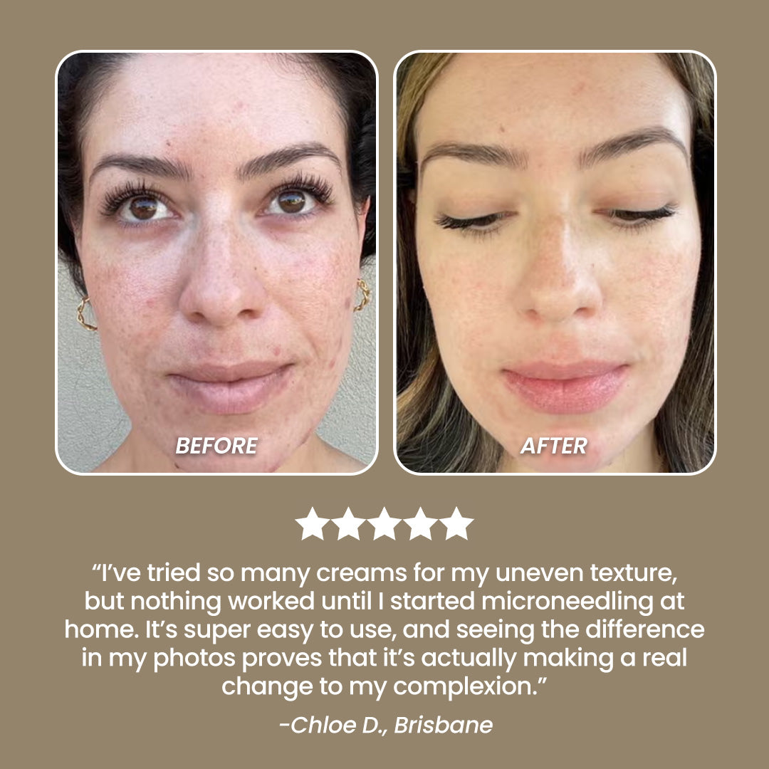 SkinNeedlePro™ At-Home Microneedling Pen for Skin Rejuvenation