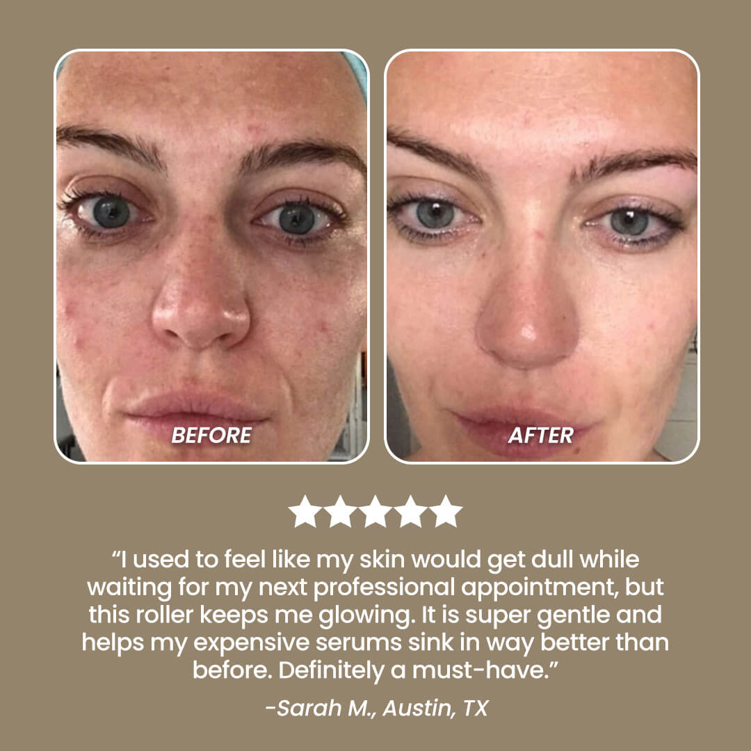 SkinNeedlePro™ Derma Roller for In-Between Microneedling