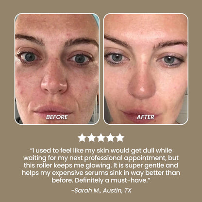SkinNeedlePro™ Derma Roller for In-Between Microneedling