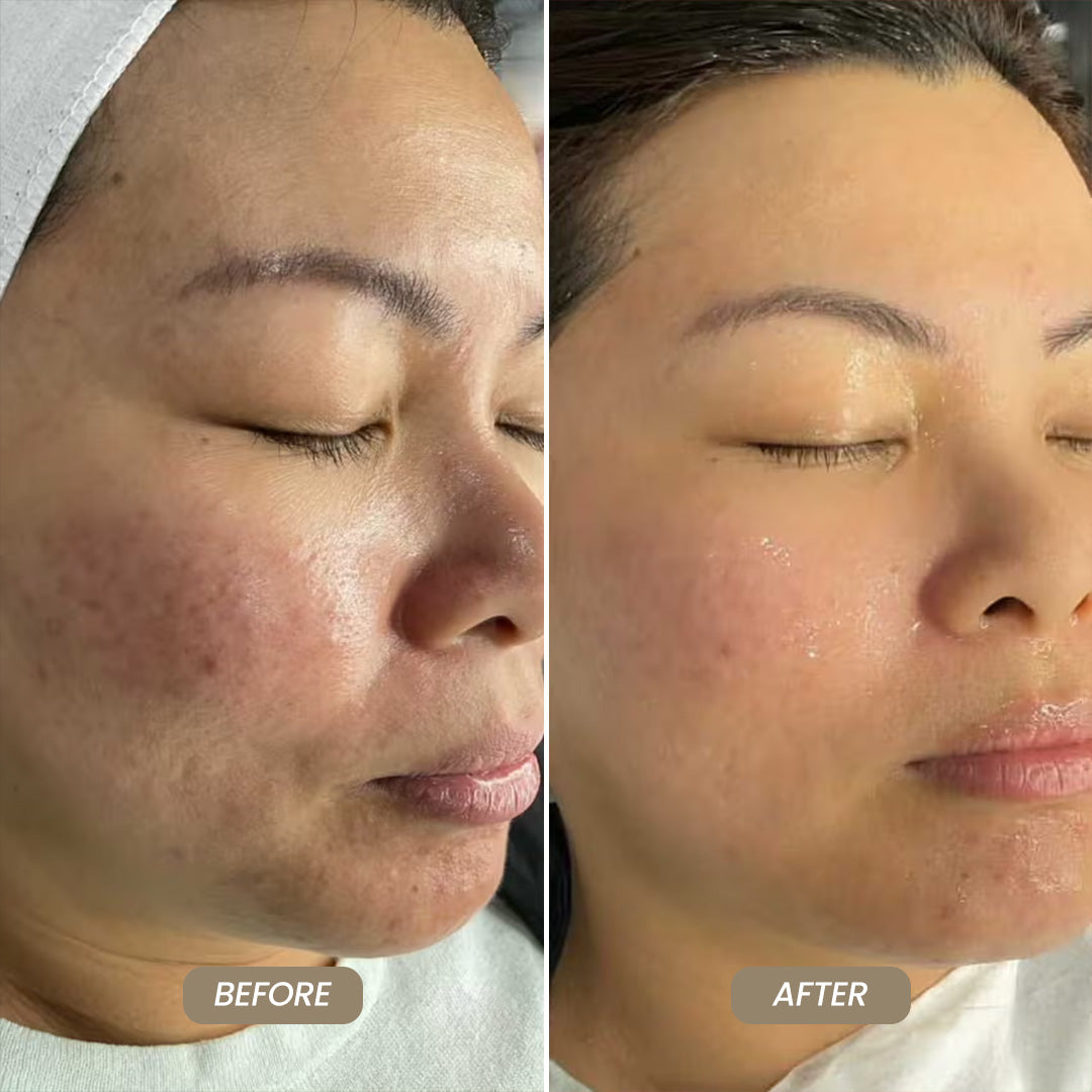 SkinNeedlePro™ At-Home Microneedling Pen for Skin Rejuvenation