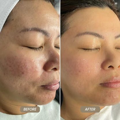 SkinNeedlePro™ At-Home Microneedling Pen for Skin Rejuvenation