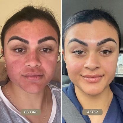 SkinNeedlePro™ At-Home Microneedling Pen for Skin Rejuvenation