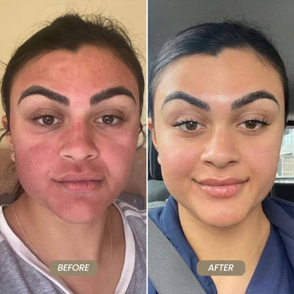 SkinNeedlePro™