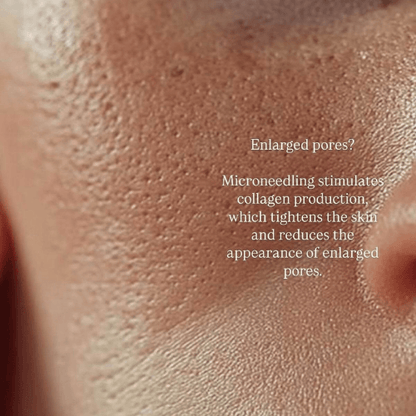 SkinNeedlePro™